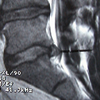 Prolapsed Intervertebral Disc