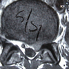 Prolapsed Intervertebral Disc