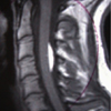 Cervical Spinal Tumours