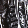 Prolapsed Intervertebral Disc