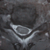 Prolapsed Intervertebral Disc